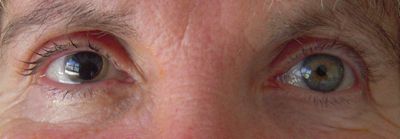 Crystalline eye implants